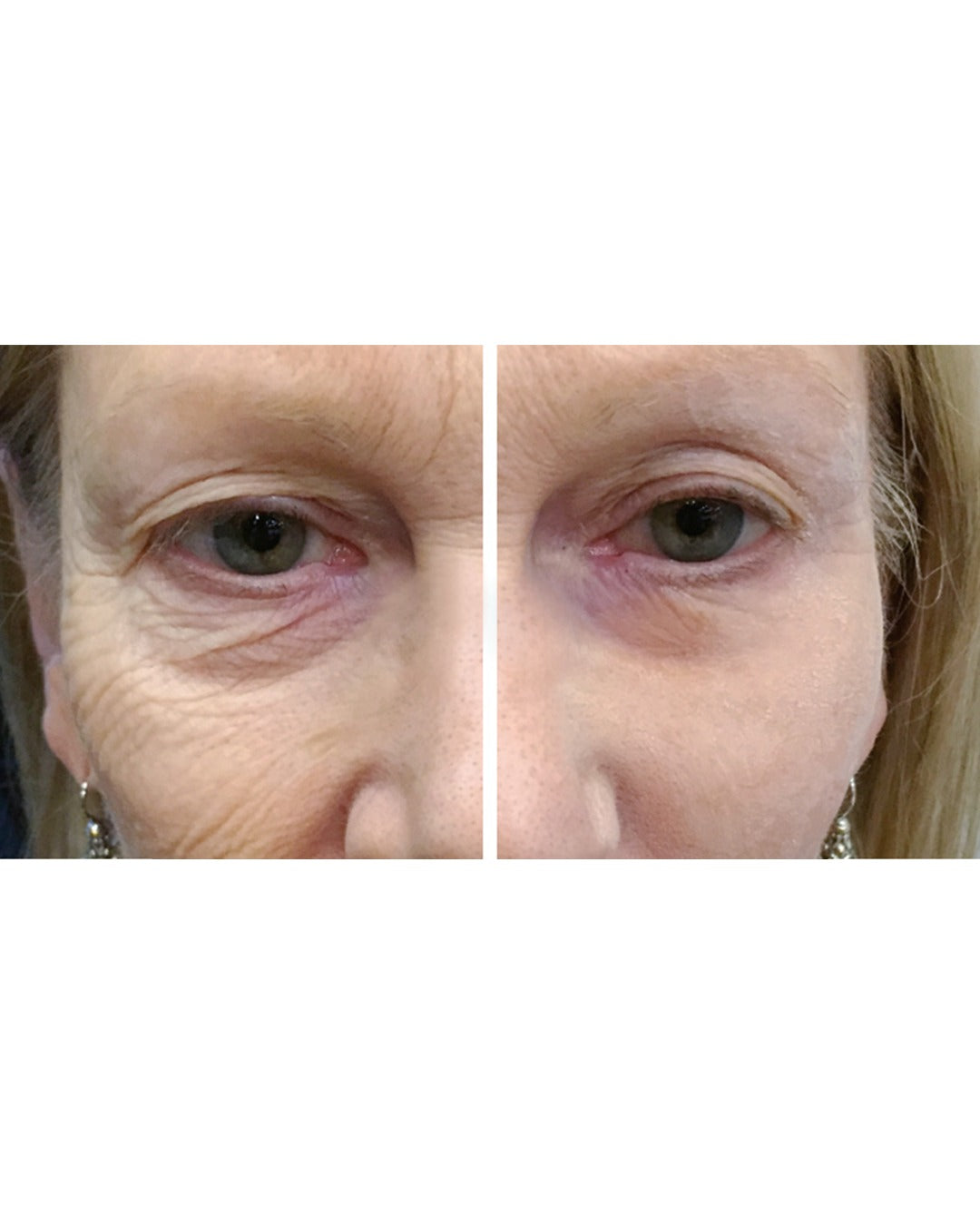 למראה בוטוקס טבעי GLO24K תוצאות לפני ואחרי שימוש בקרם אנטי אייג'ינג