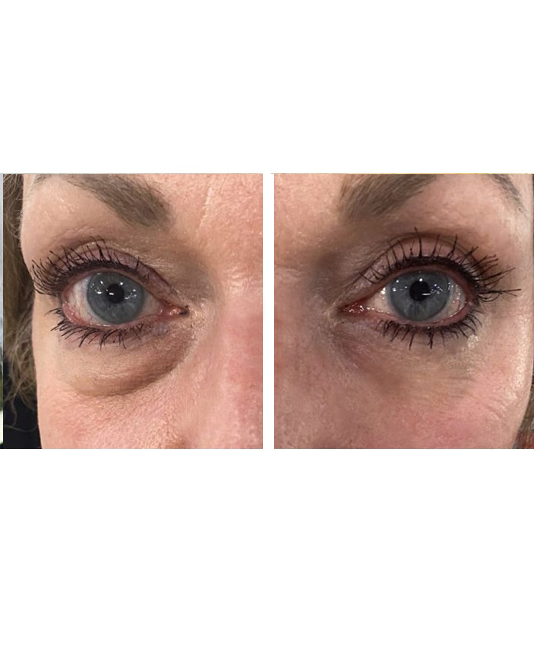 לפני ואחרי שימוש ב קרם פנים אנטי אייג'ינג